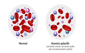 Cara Mengobati Anemia Aplastik