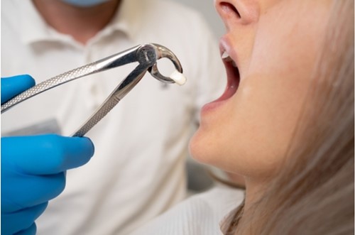 Harga Cabut Gigi di Puskesmas Tanpa BPJS